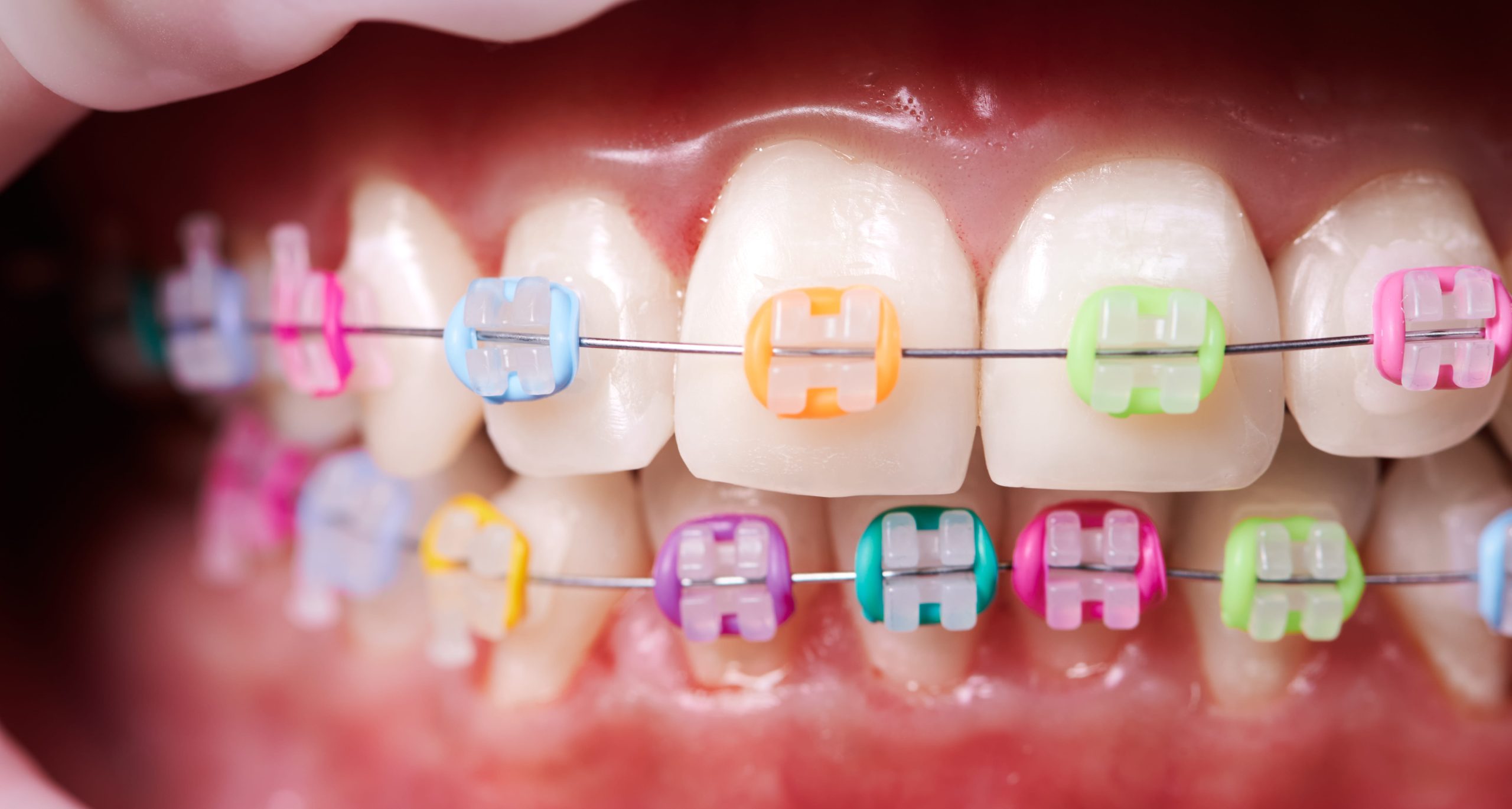 Braces dentist in Windsor, CO