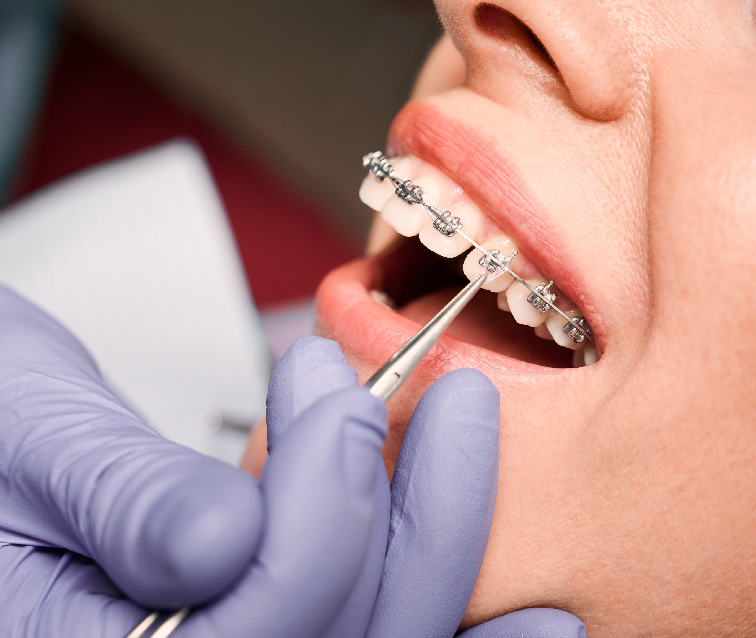 Metal braces orthodontist in Windsor, CO