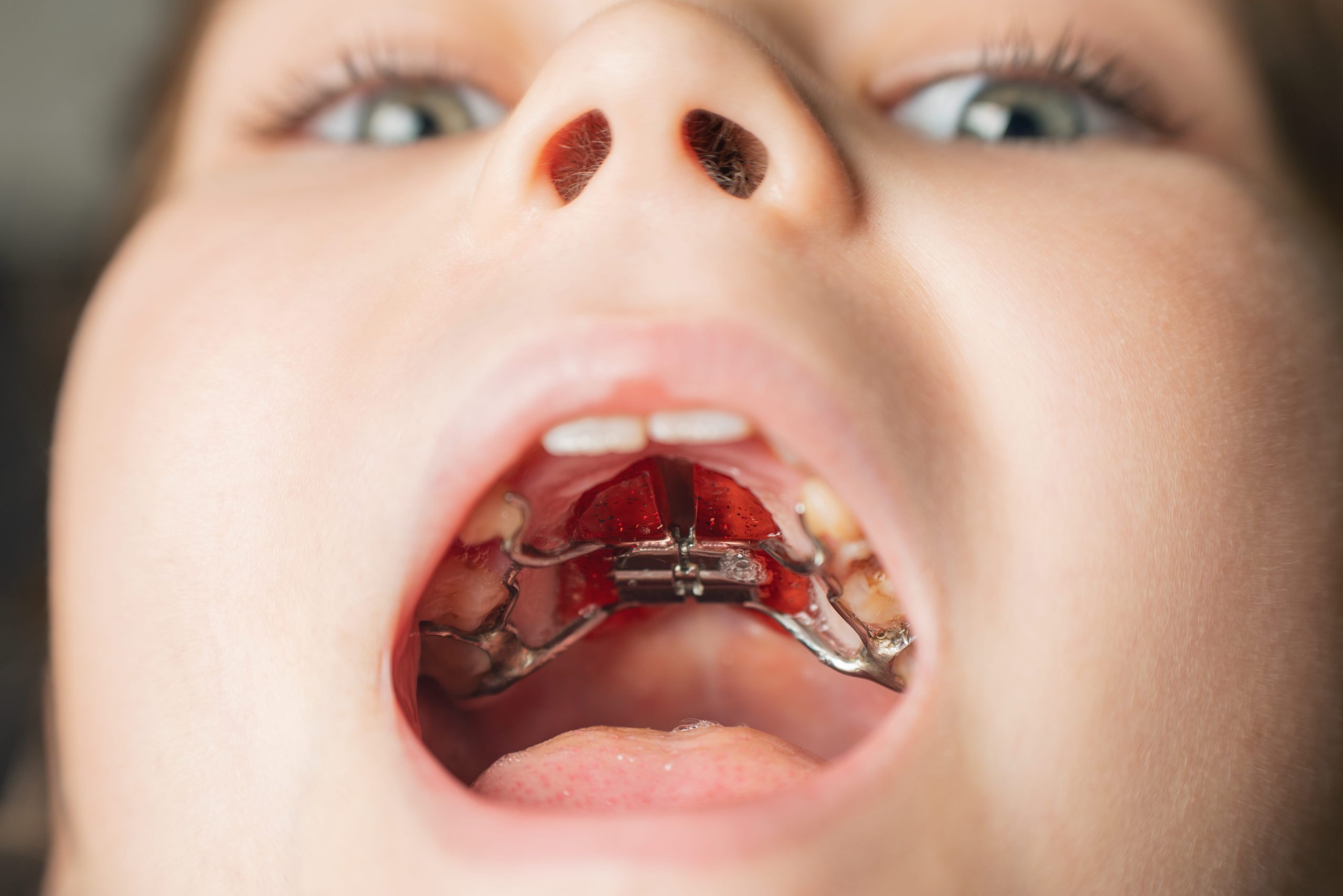 Palatal Expander treatment in Windsor, CO